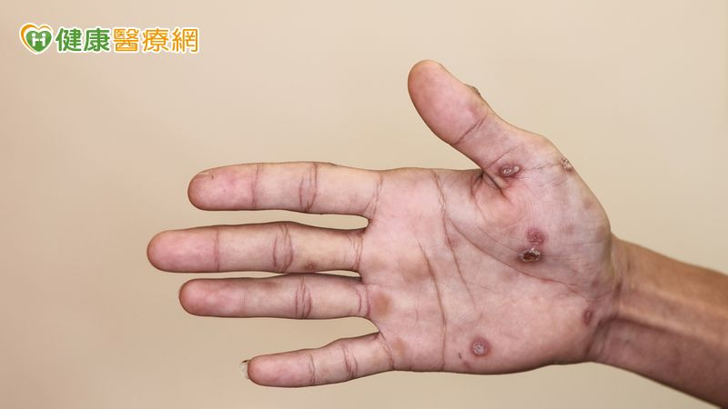 手腳紅斑不癢!他問AI竟罹「梅毒二期」 醫點頭揭成因