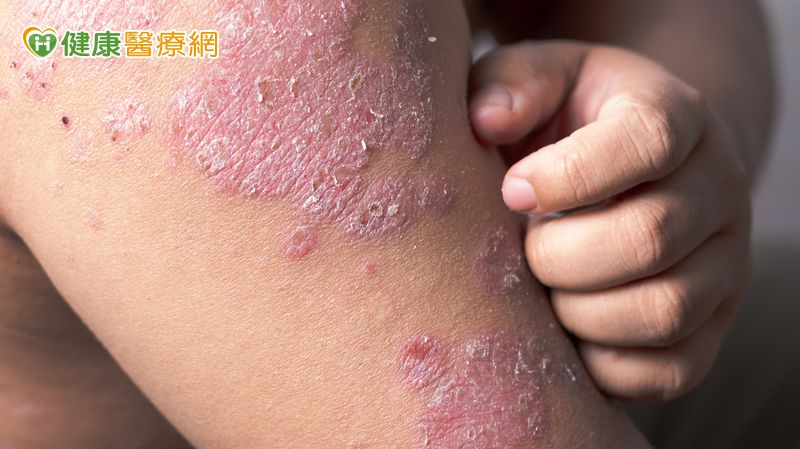 抓到滿身傷還治不好?醫揭「異位性皮膚炎關鍵解方」重拾生活品質