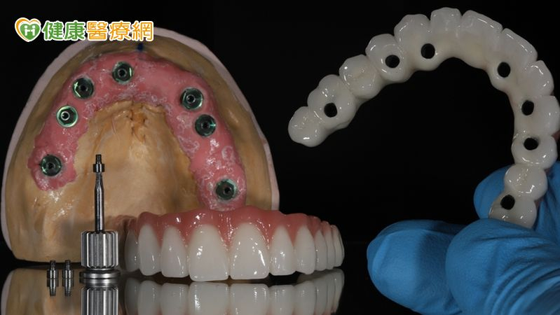 全口重建進入「精準導航」時代!「四支植體結合AI」撐起一口好牙