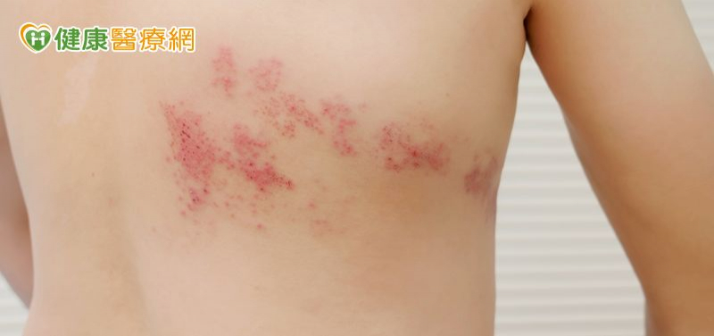背痛到像被火燒竟是帶狀皰疹!醫:「這樣做」可大幅降低復發與後遺症
