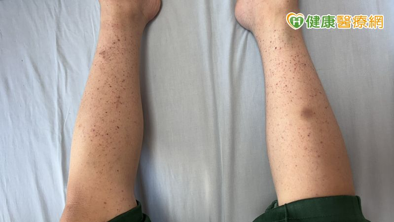 8歲童全身冒小血斑、剔牙大出血 竟是「免疫性紫斑症」險致命