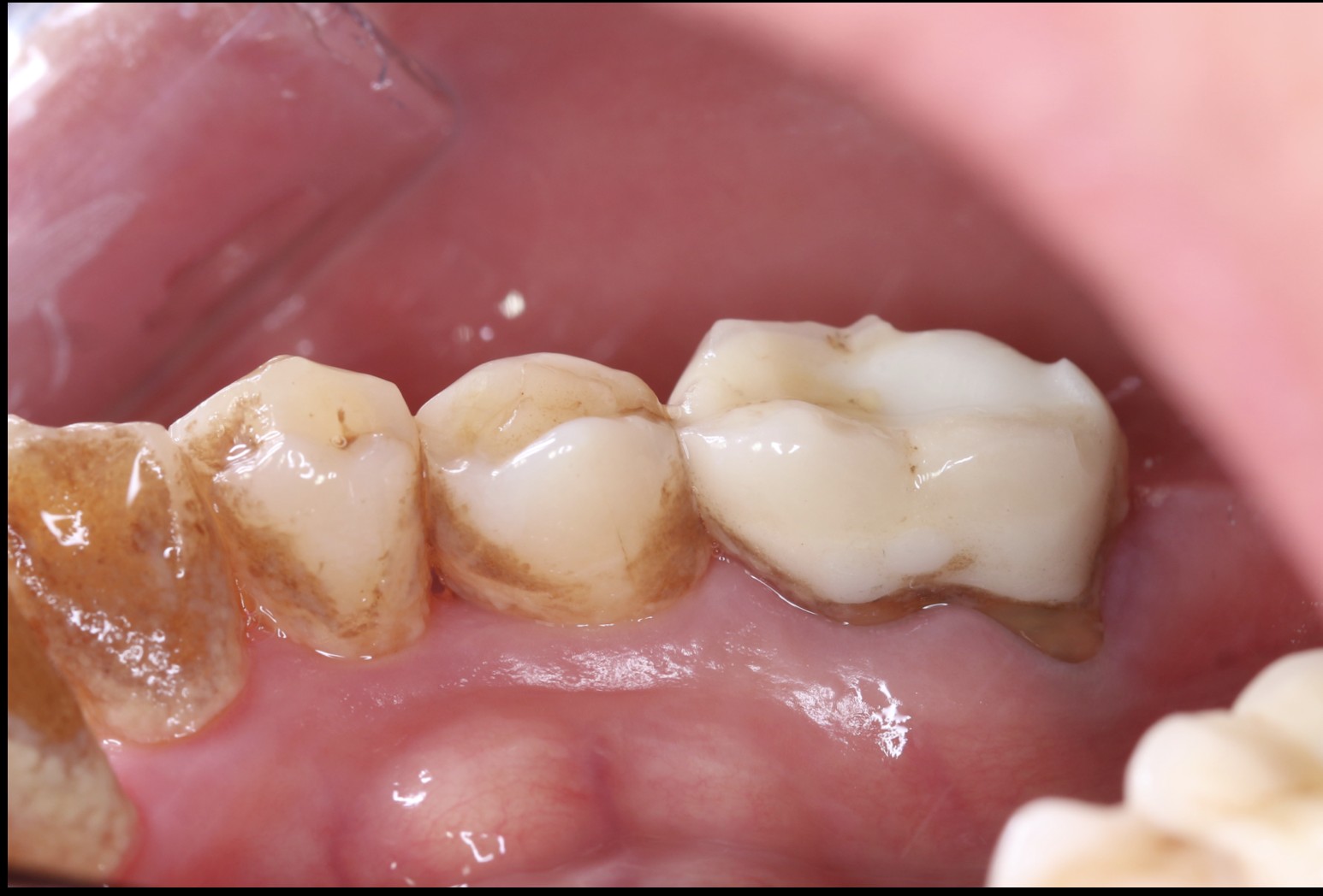 35歲以上民眾9成有牙周病變!恩主公醫:光是每天刷牙還不夠