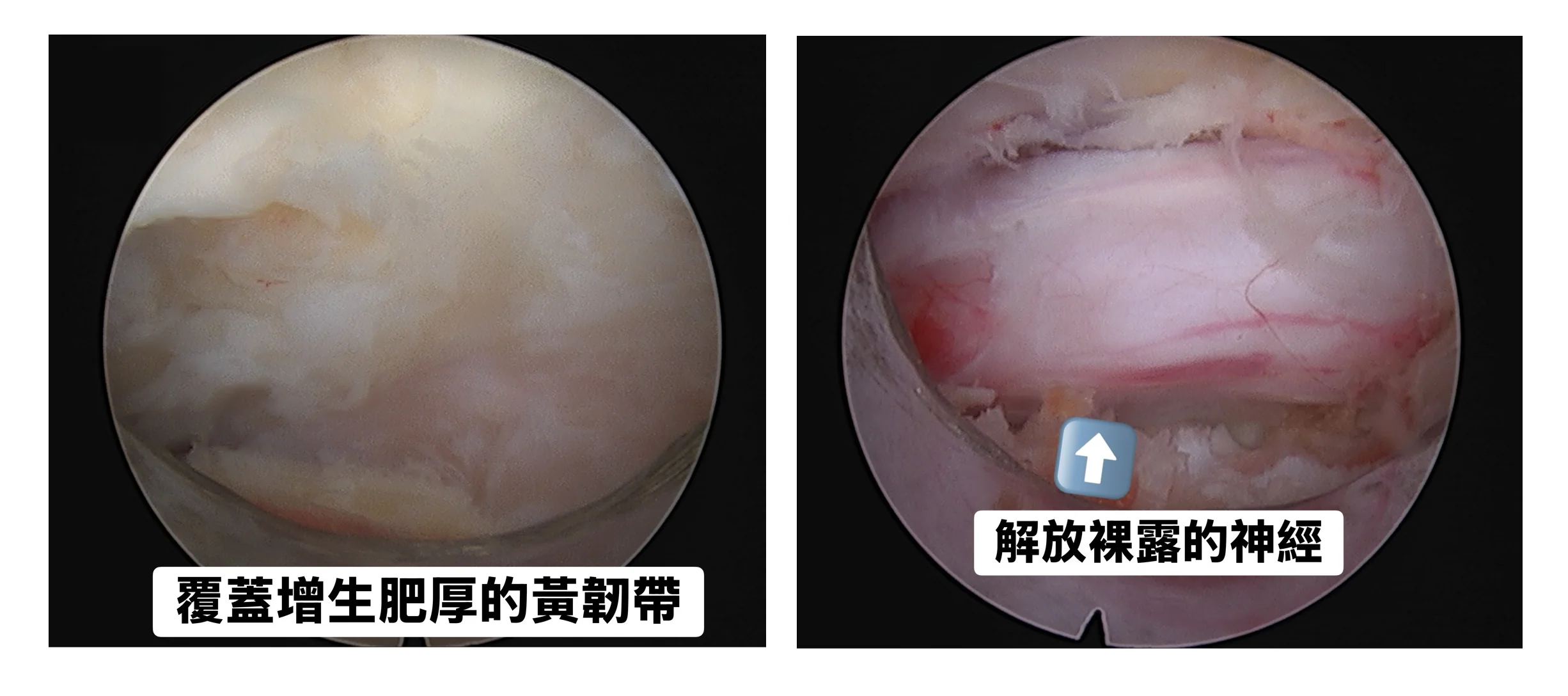 「脊椎鄰近節病變」走不到100公尺!聯新國際醫院1招讓她回歸日常生活 內視鏡手術過程 0