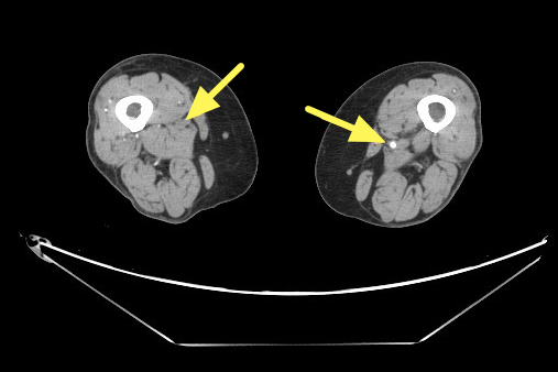 天冷腳麻是血管慢性壞死警訊!聯新國際醫院:嚴重恐截肢 右股動脈脈阻塞左側箭號處 f 0