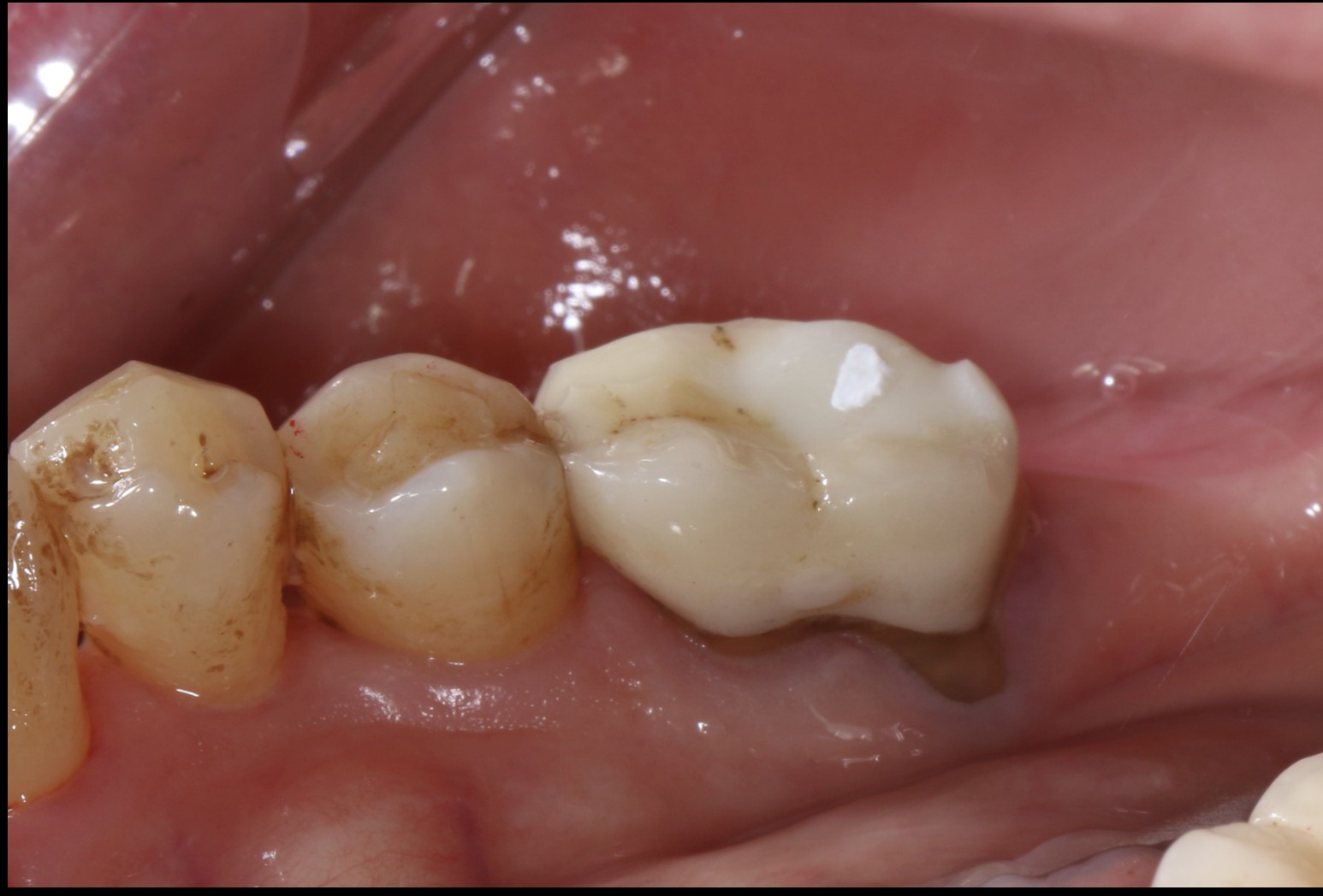 圖二 個案女主管看診後並落實正確牙齒清潔後，牙齒牙菌斑已明顯清除。