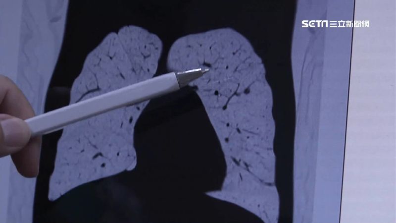 戒菸2年仍罹肺癌!她篩檢揪出1.2公分結節