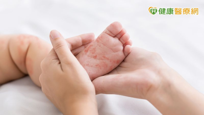 今年首例麻疹境外移入!8個月男嬰自越南返台確診 7國列第二級警示