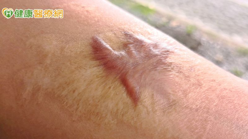 每天睡不到兩小時!中年女罹「蟹足腫」困擾30年 跨科聯手救回她的睡眠