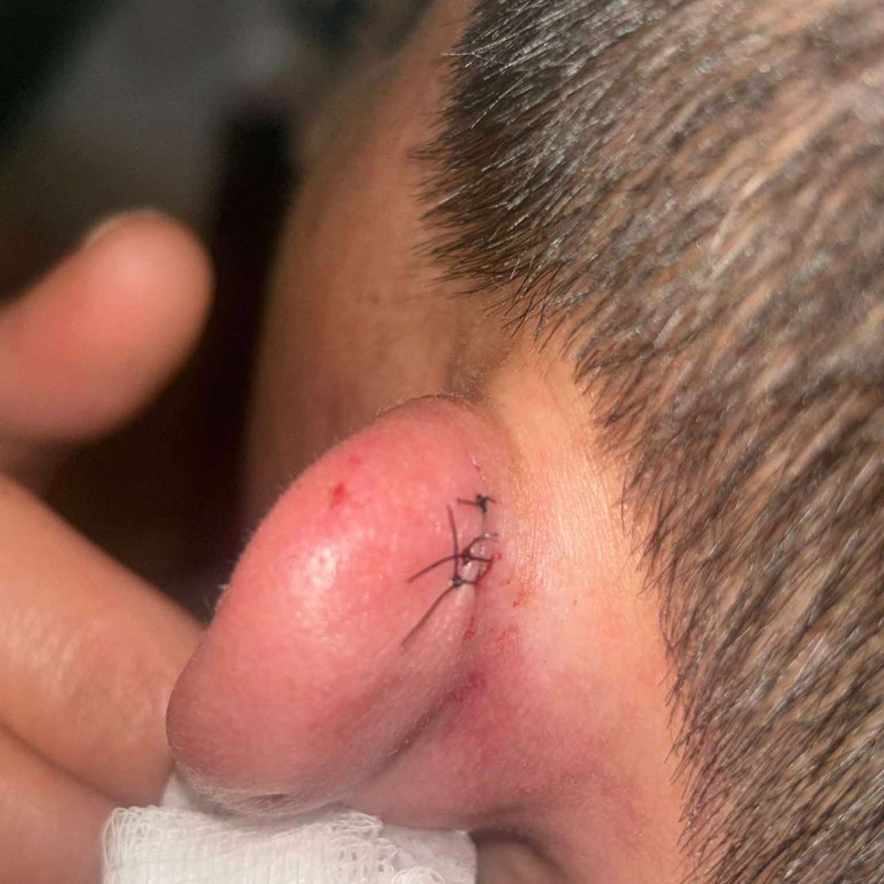 排發財金竟變流血衝突!民眾PO驗傷單控遭「甩棍攻擊」