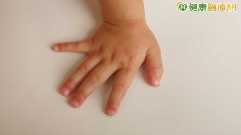 腸病毒重症添2例!國中生手腳無力住ICU 未滿5歲童腦炎搶救中 腸病毒重症添2例!國中生手腳無力住ICU 未滿5歲童腦炎搶救中