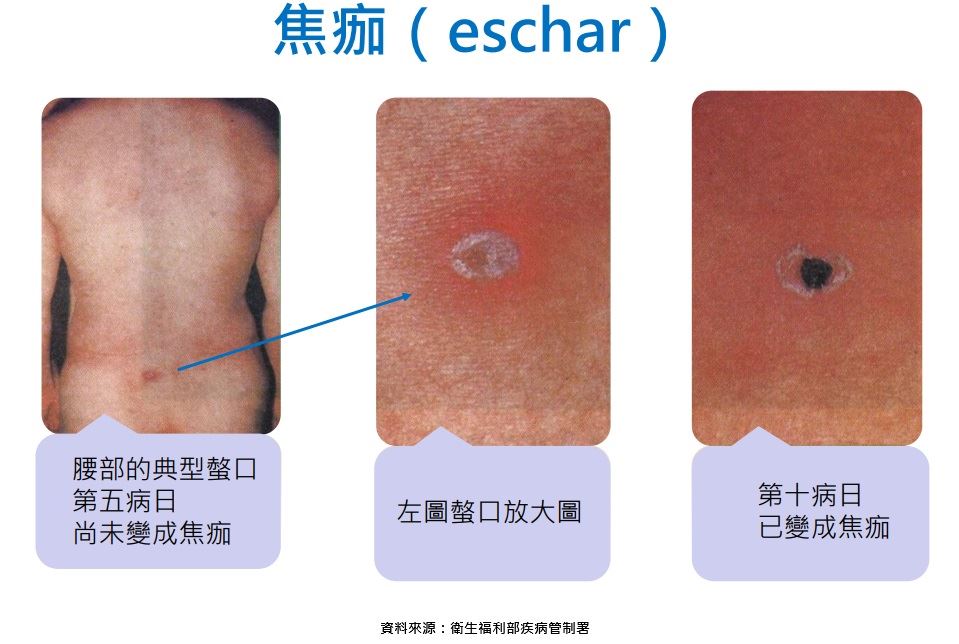 清明掃墓防恙蟲!桃市衛生局示警:出現「黑色焦痂」快就醫 123 17
