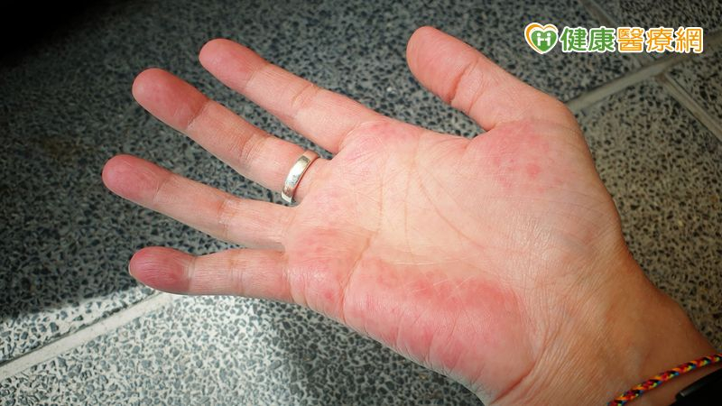 紅斑性狼瘡折磨睡不著、傷口難癒 高壓氧治療助改善症狀 紅斑性狼瘡折磨睡不著、傷口難癒 高壓氧治療助改善症狀