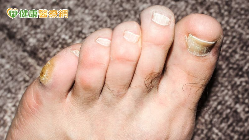 糖友穩定控制血糖卻忽略糖尿病足!醫及時救回避免截肢 糖友穩定控制血糖卻忽略糖尿病足!醫及時救回避免截肢