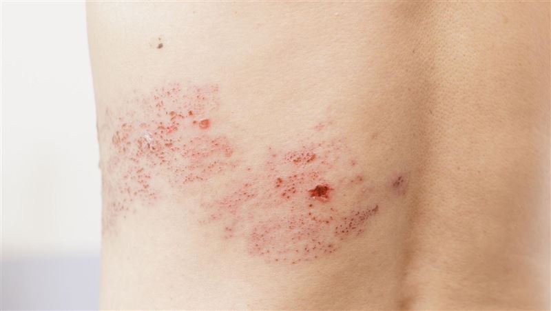 皮蛇發生率12年增1.72倍 30歲以上慢性病患風險接近高齡族群