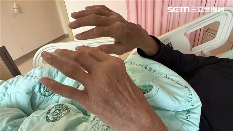 6旬男不忌口 腳踝「雞蛋般大」痛風石破裂爆漿 6旬男不忌口 腳踝「雞蛋般大」痛風石破裂爆漿