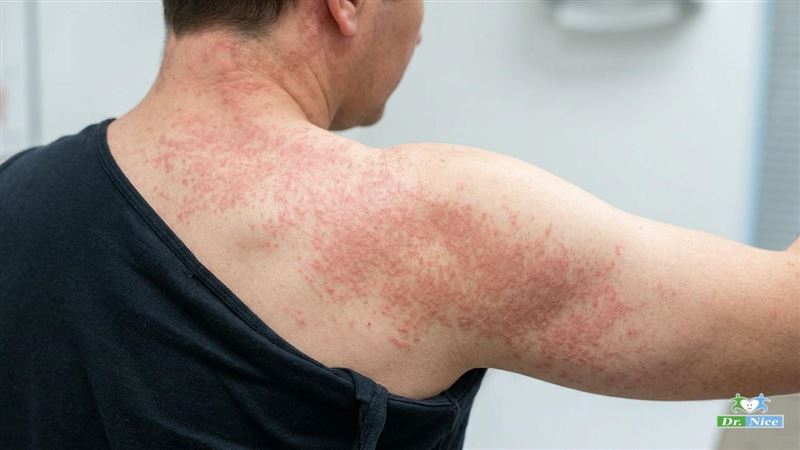 春分到!醫提醒留意麻疹 三階段病程症狀曝光 春分到!醫提醒留意麻疹 三階段病程症狀曝光