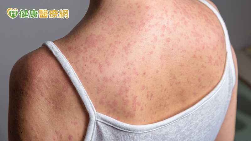 麻疹移入增2例!北部5旬女「無紅疹」併發腦炎住加護 疾管署這麼說 麻疹移入增2例!北部5旬女「無紅疹」併發腦炎住加護 疾管署這麼說