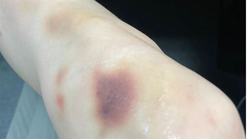 車禍止不住血竟被迫截肢!血友病友痛揭心聲:規律治療是活下去的唯一路 車禍止不住血竟被迫截肢!血友病友痛揭心聲:規律治療是活下去的唯一路