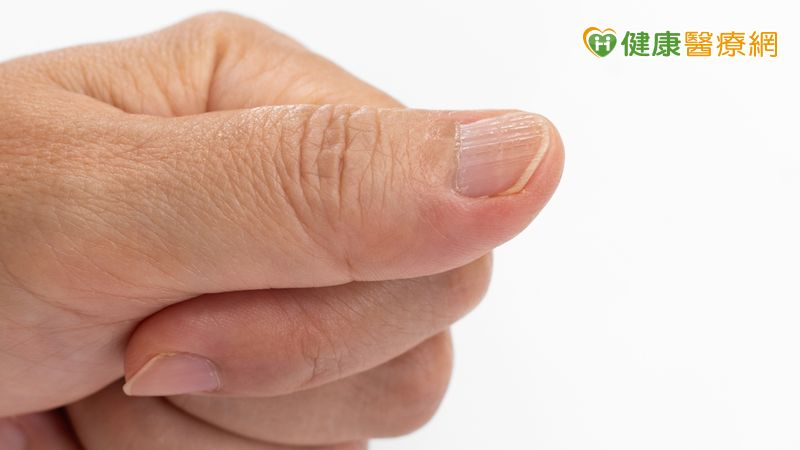 指甲不平整、直條紋現蹤?醫揭「甲下腫瘤警訊」 指甲不平整、直條紋現蹤?醫揭「甲下腫瘤警訊」