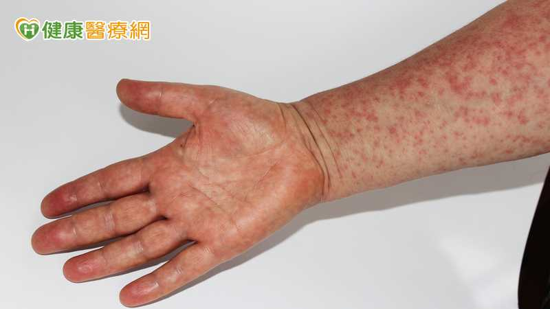 國際疫情持續!印尼返台男染麻疹 疾管署匡列384人監測至4/21 國際疫情持續!印尼返台男染麻疹 疾管署匡列384人監測至4/21