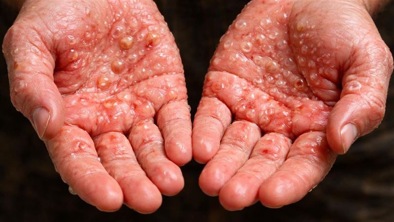 手掌出現水泡「不是濕疹」醫警告:恐是這病 手掌出現水泡「不是濕疹」醫警告:恐是這病