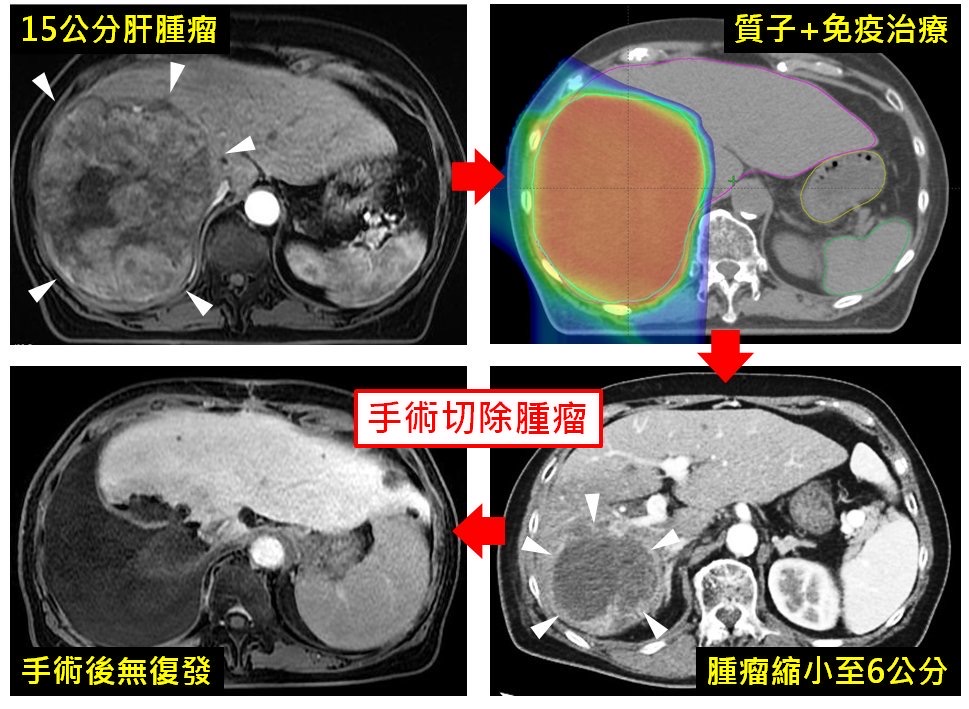 林口長庚質子合併免疫治療奏效 中晚期肝癌生機重現存活率達77% S 3883082