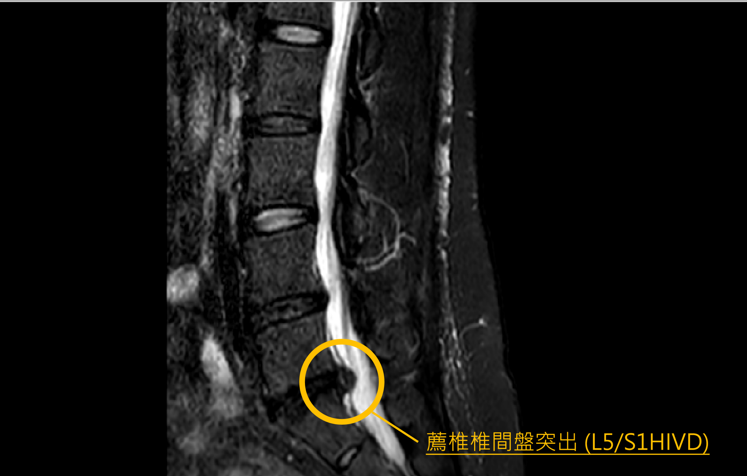 「甩棉被」釀椎間盤突出影響行走 桃園醫院微創手術助她恢復正常生活 h5e4w54r scaled
