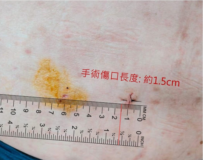 「甩棉被」釀椎間盤突出影響行走 桃園醫院微創手術助她恢復正常生活 術後傷口