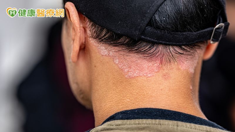 染新冠後全身爆膿疱!醫揭「罕見免疫反應」:與基因突變有關 染新冠後全身爆膿疱!醫揭「罕見免疫反應」:與基因突變有關
