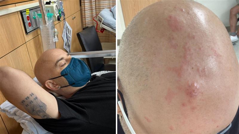 吳鳳因帶狀皰疹住院治療 讚嘆台灣醫療健保完善 吳鳳因帶狀皰疹住院治療 讚嘆台灣醫療健保完善