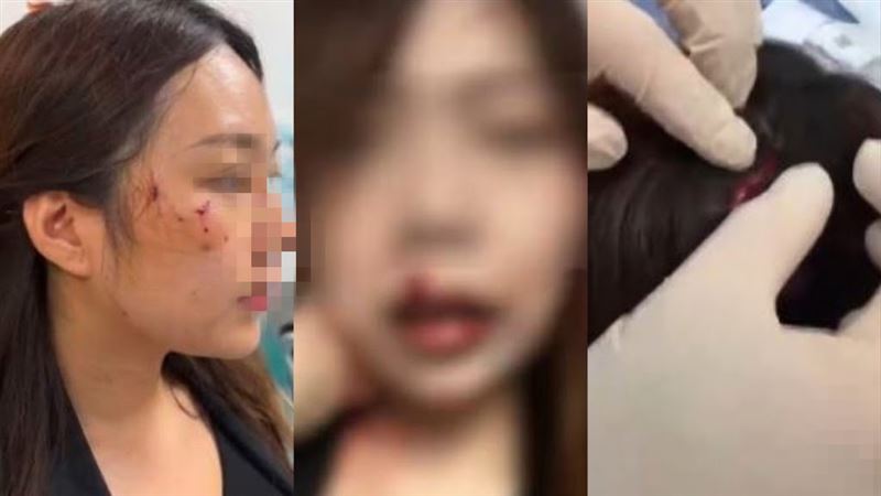 家貓養了2年突然暴走!女子遭攻擊頭皮被撕開 家貓養了2年突然暴走!女子遭攻擊頭皮被撕開