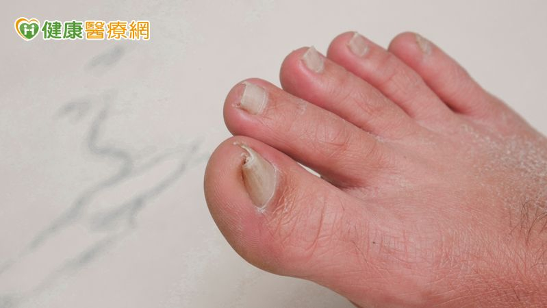 凍甲拔4次仍復發、「捲甲」痛到難穿鞋 甲床重建助甩寸步難行之苦 凍甲拔4次仍復發、「捲甲」痛到難穿鞋 甲床重建助甩寸步難行之苦