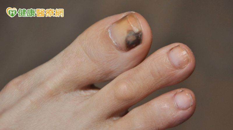 黑痣快速擴大恐是惡性黑色素瘤 醫揭免疫治療機轉與防護重點 黑痣快速擴大恐是惡性黑色素瘤 醫揭免疫治療機轉與防護重點