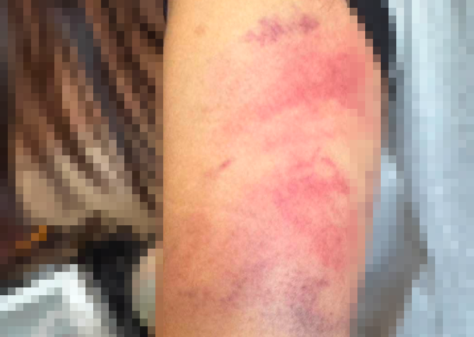 桃園女學生被打到手臂紅腫瘀血 父疑威脅「不回家就改打手足」 hget